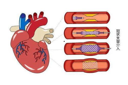 心脏支架手术视频